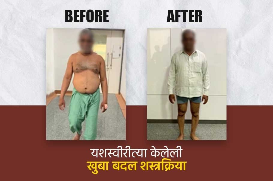 खुबा बदल शस्त्रक्रिया