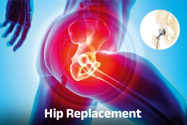 Pain relief through Replacement Surgery